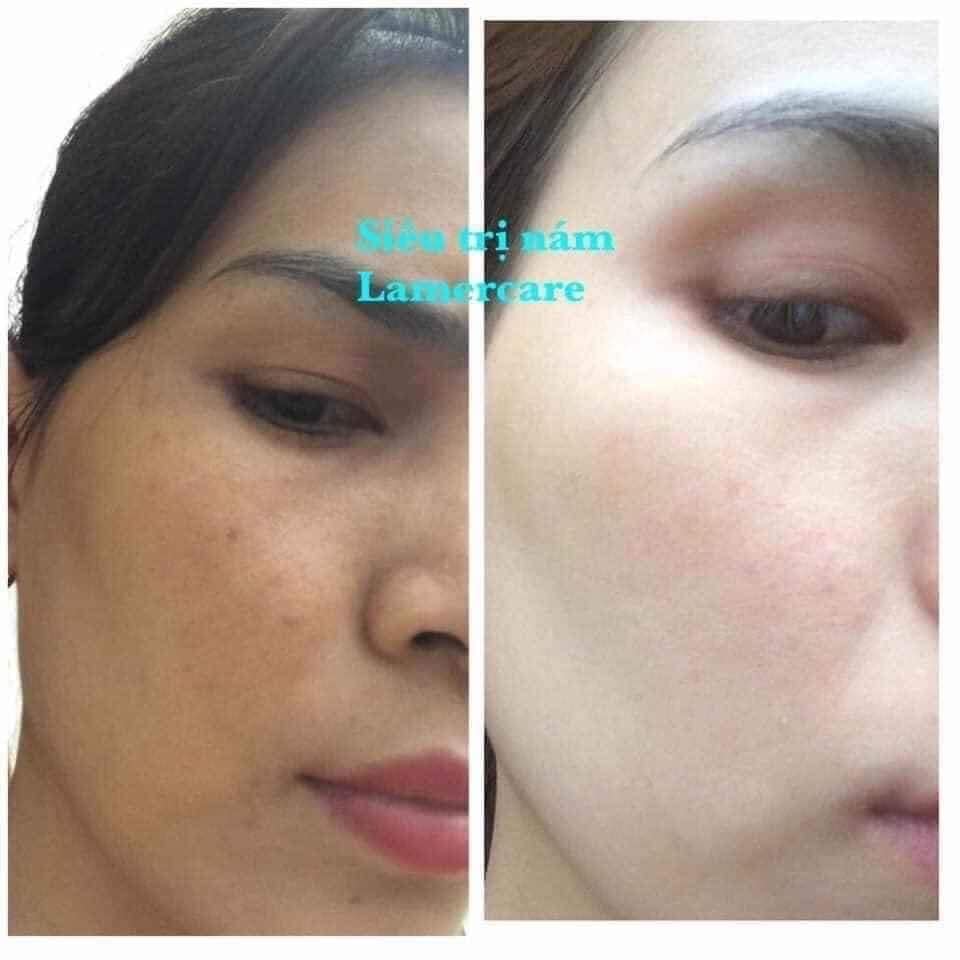 Sản Phẩm Trị Nám Hiệu Quả Nhất Hiện Nay
