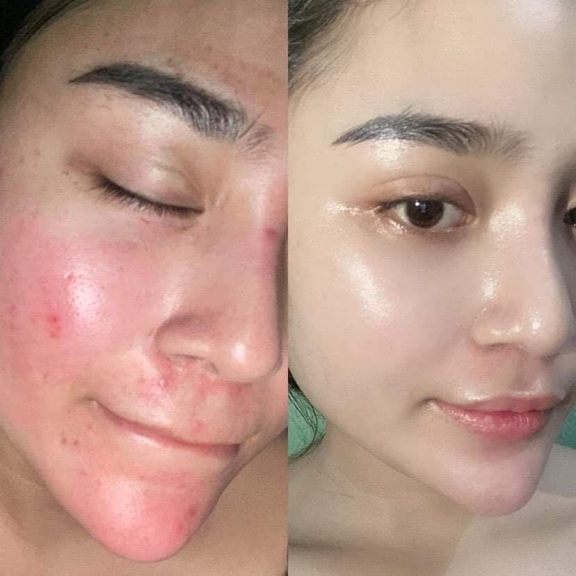 Phản hồi của khách về tái tào tế bào gốc táo Dr.lacir